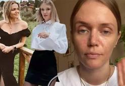 Ecem Karavus: Artık suratım şiddetle mücadele edemiyor, 50 gündür sürüyor