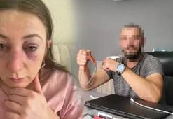 Eski sevgilisi dehşet saçtı! Yüzü tanınmaz hale geldi