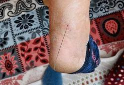 Ayak topuğundan 37 santim tel çıktı! Suç duyurusunda bulundu