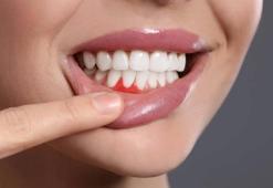 Diş Apsesi Nasıl Geçer? Diş Apsesi Geçiren Yöntemler, Püf Noktaları Nelerdir?