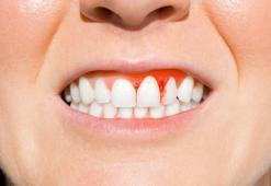 Diş Eti İltihabı Nasıl Geçer? Diş Eti İltihabı Geçiren Yöntemler, Püf Noktaları Nelerdir?