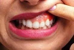 Diş Eti Şişmesi Nasıl Geçer? Diş Eti Şişmesi Geçiren Yöntemler, Püf Noktaları Nelerdir?