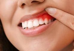 Diş İltihabı Nasıl Geçer? Diş İltihabı Geçiren Yöntemler, Püf Noktaları Nelerdir?