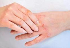 Egzama Nasıl Geçer? Egzama Geçiren Yöntemler, Püf Noktaları Nelerdir?