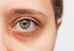 Göz Altı Morlukları Nasıl Geçer? Göz Altı Morlukları Geçiren Yöntemler, Püf Noktaları Nelerdir?