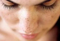 Güneş Lekesi Nasıl Geçer? Güneş Lekesi Geçiren Yöntemler, Püf Noktaları Nelerdir?