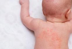 İsilik Nasıl Geçer? İsilik Geçiren Yöntemler, Püf Noktaları Nelerdir?