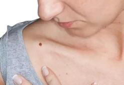 Benler vücudun o bölgesinde çıkıyorsa dikkat! 30 yaş kritik: Benler çoğaldığında ne yapmalıyız?
