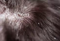 Kepek Nasıl Geçer? Kepek Geçiren Yöntemler, Püf Noktaları Nelerdir?