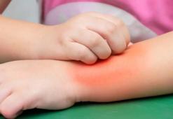 Kurdeşen Nasıl Geçer? Kurdeşen Geçiren Yöntemler, Püf Noktaları Nelerdir?