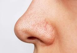 Siyah Nokta Nasıl Geçer? Siyah Nokta Geçiren Yöntemler, Püf Noktaları Nelerdir?