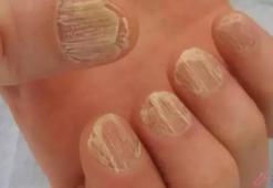 Tırnak Mantarı Nasıl Geçer? Tırnak Mantarı Geçiren Yöntemler, Püf Noktaları Nelerdir?