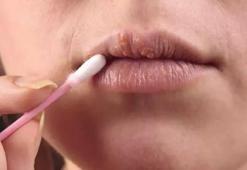 Uçuk Nasıl Geçer? Uçuk Geçiren Yöntemler, Püf Noktaları Nelerdir?
