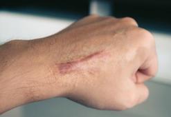 Yanık İzi Nasıl Geçer? Yanık İzi Geçiren Yöntemler, Püf Noktaları Nelerdir?