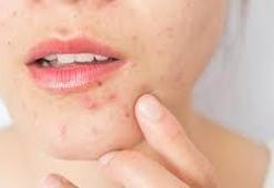 Yüzdeki Sivilce Nasıl Geçer? Yüzdeki Sivilce Geçiren Yöntemler, Püf Noktaları Nelerdir?