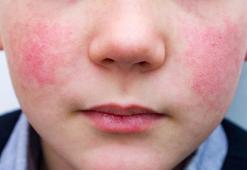 Tokatlanmış yanak sendromu yaygınlaştı! Uzman isimden pembe yanak sendromu için uyarılar geldi