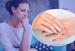 Nedeni bilinmiyor, fiziksel hasara yol açıyor! Uzmanı uyardı: Yüz, kollar, bacaklar ve tırnak etleri hedeflenir