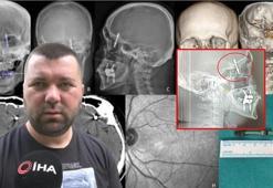 Diş tedavisinde korkunç son! Vida beynine saplandı, doktor hastaneye bırakıp kaçtı