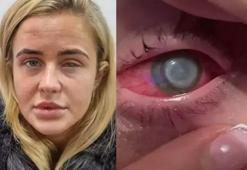 Kaşıntıyla başladı, 22 yaşında gözünün rengi değişti! Meğer tek yaptığı şey gözünü kör etmiş