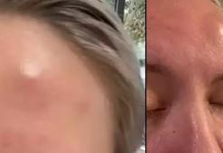 Yaptırdığı botoks 8 yıl sonra bile başına iş açtı! Şişlikler herkesi dehşete düşürdü