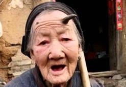 76 yaşındaki kadının alnında boynuz çıktı, çenesine kadar uzandı! 20 santimlik boynuzun nedeni dünyayı şaşkına çevirdi!