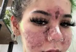 Evde yüz maskesi yaptı, yüzünü kaybetti!  Bu ürünleri çöpe atın: Plastik cerrahlar kesin uyardı!