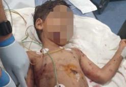 Adana'da bir çocuk sokak köpeğinin saldırısına uğradı