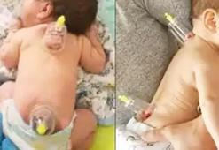 Ölüme kadar götürebilir! El kadar bebeklere hacamat yapıyorlar