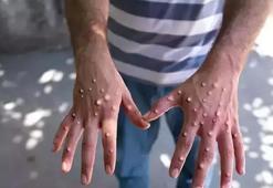 Bakan Memişoğlu: Maymun çiçeği için ekstra bir tedbire ihtiyaç yok