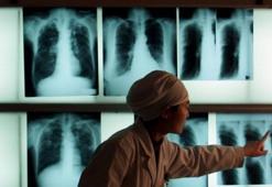 Tüberküloz yeniden en ölümcül bulaşıcı hastalık oldu