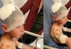 Isparta'da başıboş köpeğin saldırdığı çocuk, birçok yerinden yaralandı