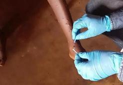 Maymun çiçeği virüsü alarmı! Vaka sayısı 4 bin 810'a yükseldi