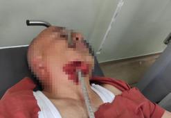 Hatay'da inşaat alanında korkunç kaza! Ayağı kayıp düşen işçinin yüzüne inşaat demiri saplandı