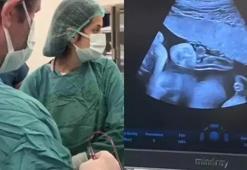 Tıpta nadir görülen operasyon! Anne karnındaki bebeğe kan nakli yapıldı