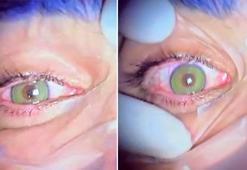 Göz rengini değiştirmek bir ameliyatla mümkün! Lazer destekli yeni yöntemler kalıcı sonuç veriyor