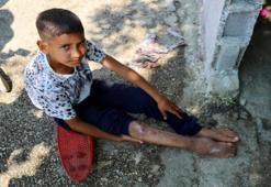 Adana'da bu da var: Baba kaçtı, anne hapiste! 11 yaşında tek ayakla yaşıyor