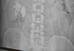 Ağrı şikayetiyle hastaneye gitti! Doktorlar dondu kaldı: 100 tane birden çıktı