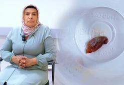 Malatya'da bir buçuk yıldan beri öksüren hastanın akciğerinde kabak çekirdeği bulundu!