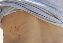 Kedi tırmalamasından kuduz olunur mu?