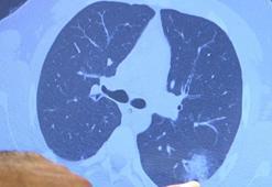 HRCT nedir? HRCT ve toraks bt farkı nedir?