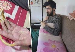 Telefon bağımlısı gencin içler acısı hali! Hatay'daki evinden 3 yıldan beri hiç çıkmadı