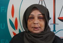 Eşinden şiddet gören kadının yüzü tanınmaz hale geldi! 'Vicdanı olan herkesten yardım istiyorum'