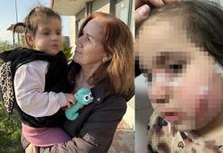 İzmir'de köpek dehşeti! 3 yaşındaki çocuğun yüzü pençe ve ısırıkla dolu