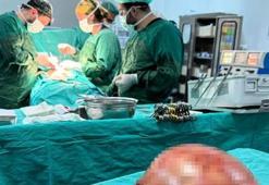 Van Yüzüncü Yıl Üniversitesi'nde bir kadının karnından 35 santimetrelik dev kitle çıkarıldı