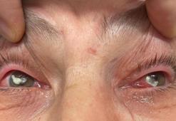 Herkes önerdi, gözlerine suyunu damlattı! Gözlükten kurtulmak isterken göremez hale geldi