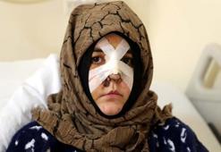 Gaziantep'te boşanma aşamasındaki eşinin yüzünü tanınmaz hale getirdi! Savcı kaldırım taşını silah sayıldığını belirtti