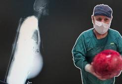 Kocaeli'de doktorlar inanamadı! Hastaneye geldi, 6,5 kilo çıktı: İlk defa bu kadar büyük gördüm