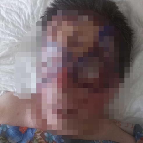 Görüşme isteğini reddeden kadına kezzaplı saldırı Sesimi duyun, gözlerimden kan geliyor