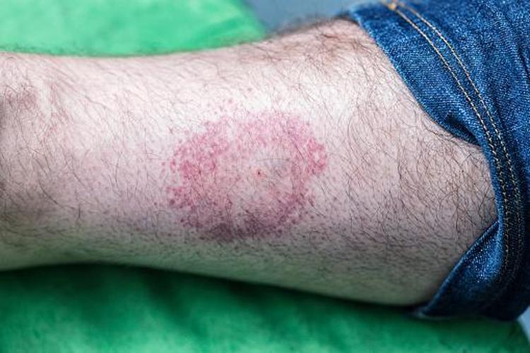 Sessiz pandemi Lyme 350 hastalığı taklit ediyor 10 milyon kişide var