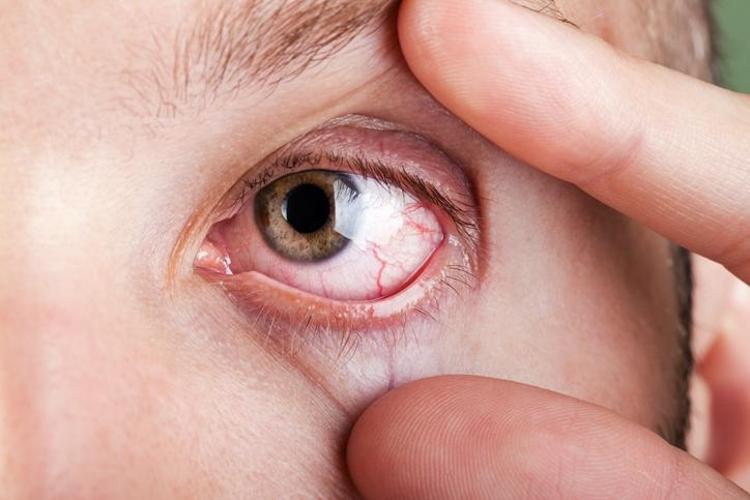 Gözün doğal görünümünü bozan hastalık: Pterjium